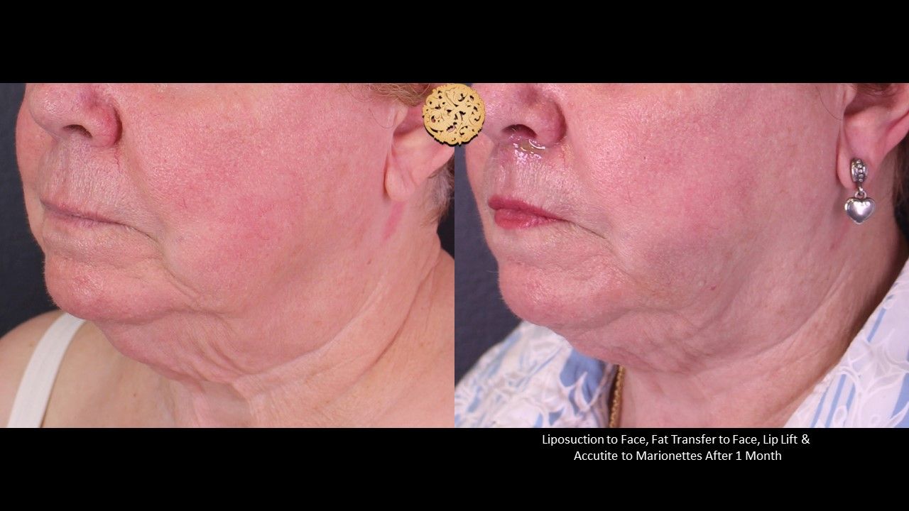Accutite Before & After