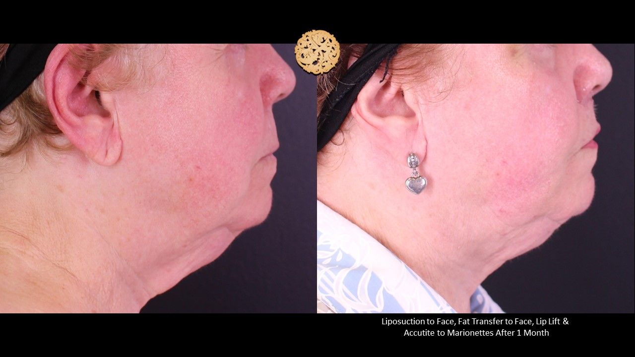Accutite Before & After