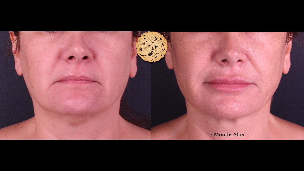 Accutite Before & After