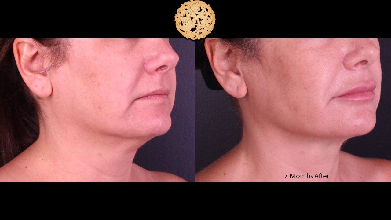 Accutite Before & After