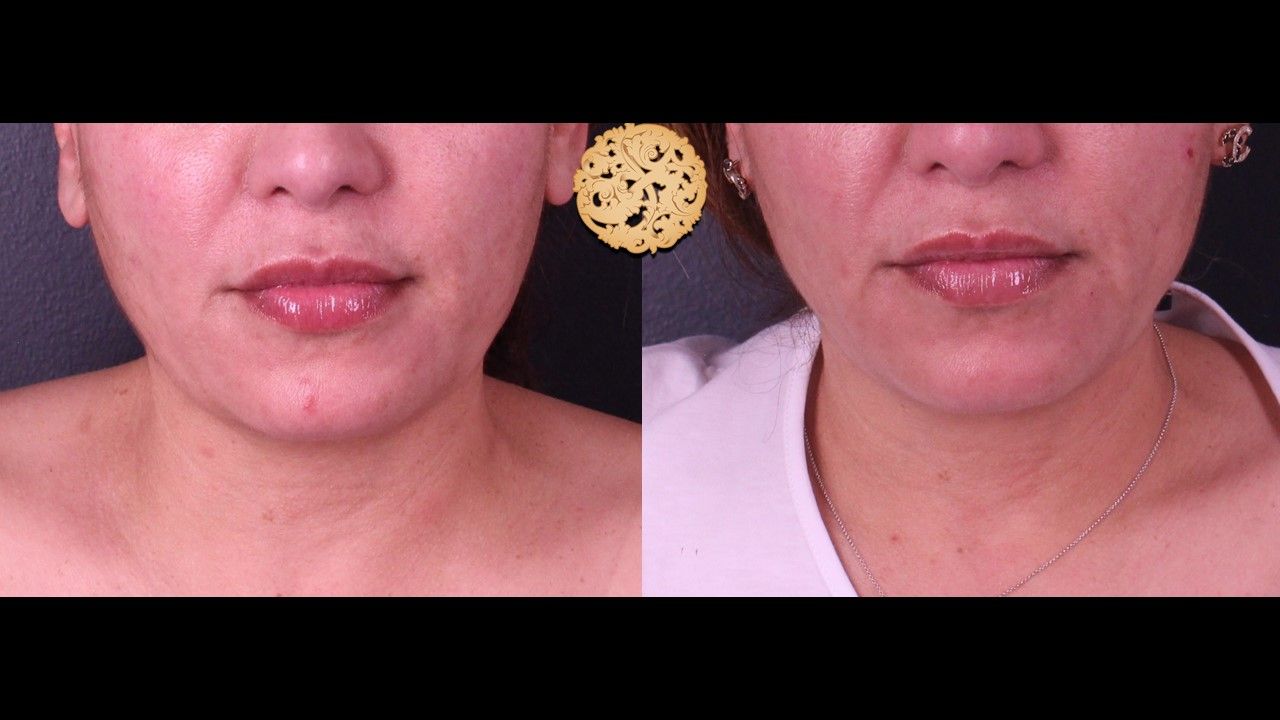 Accutite Before & After