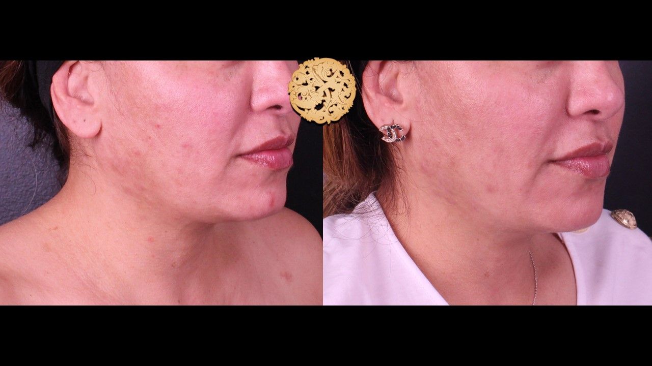 Accutite Before & After