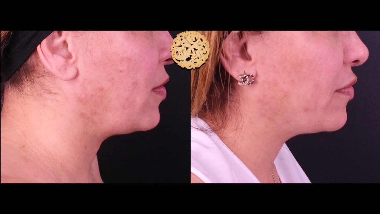 Accutite Before & After
