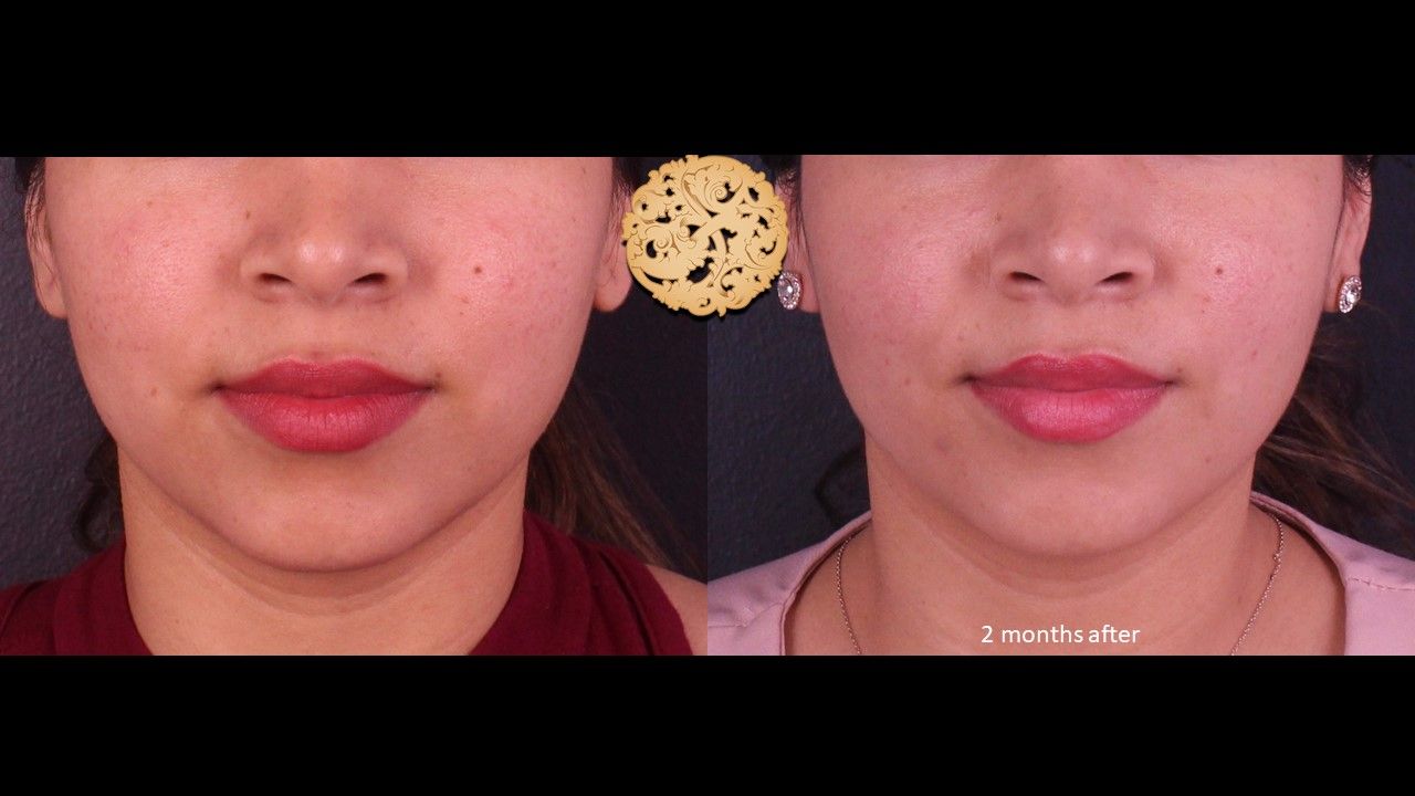 Accutite Before & After
