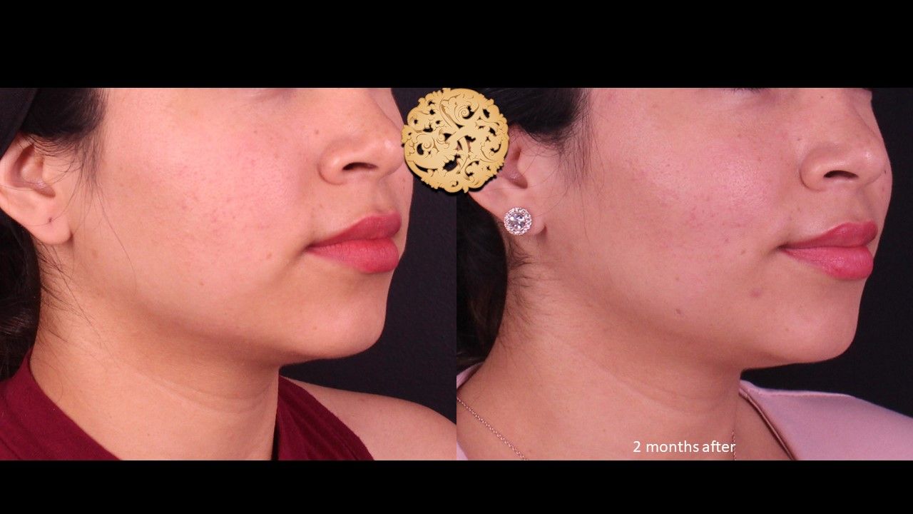 Accutite Before & After