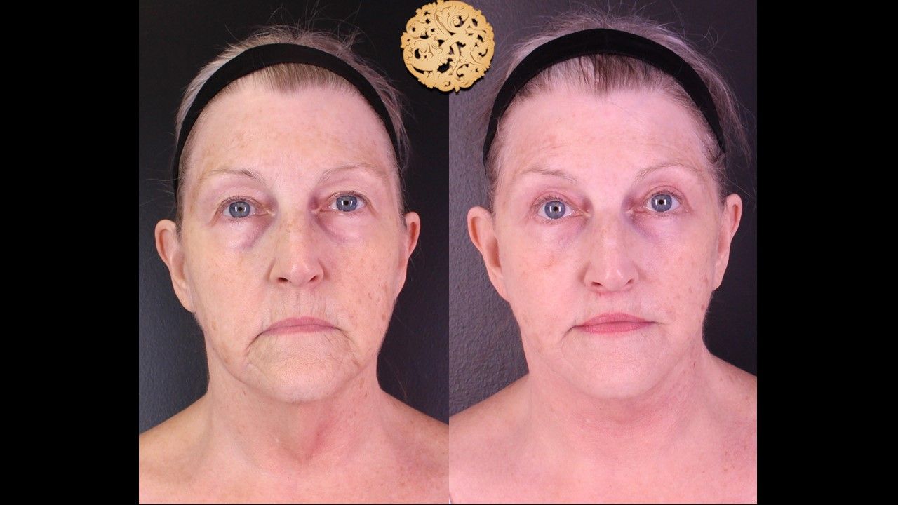 Accutite Before & After