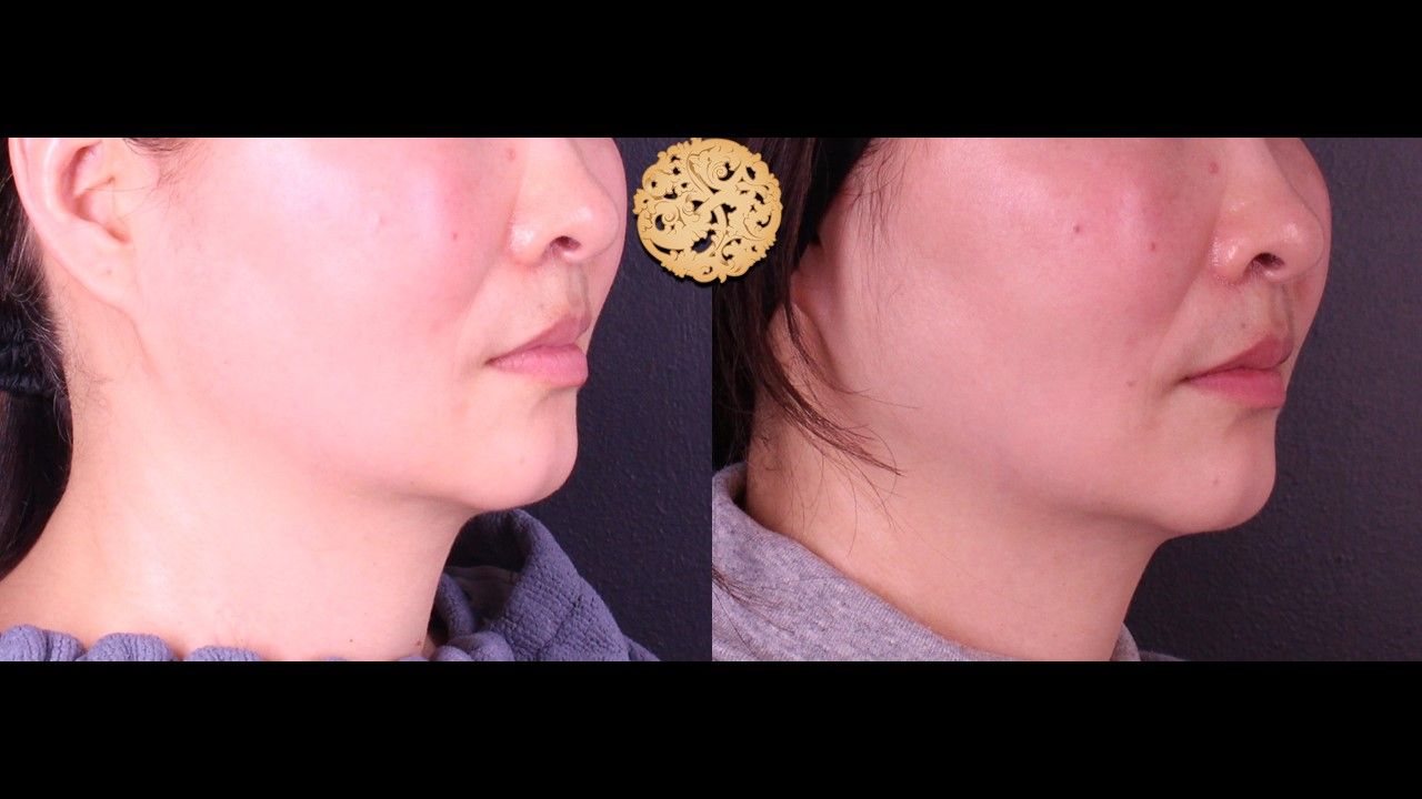 Accutite Before & After