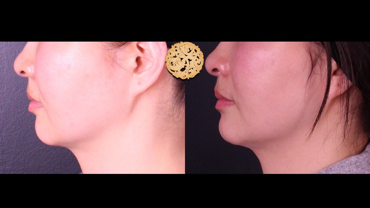 Accutite Before & After