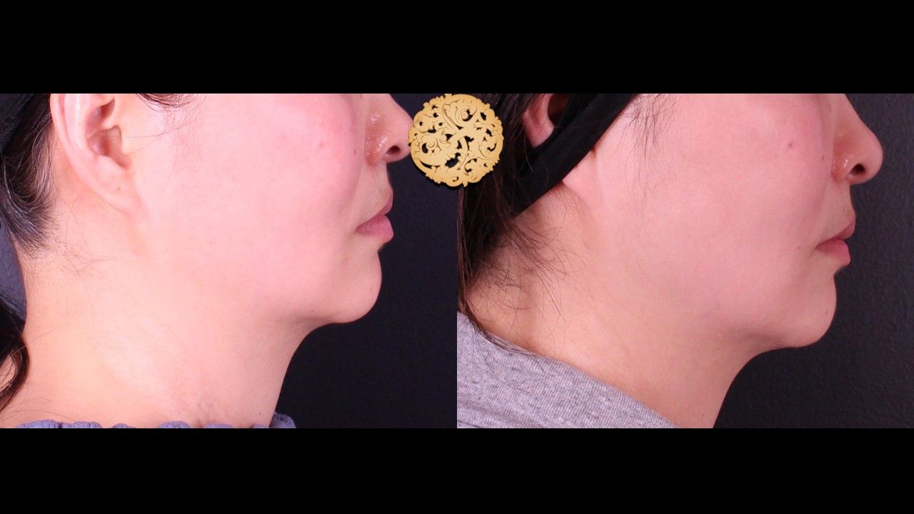 Accutite Before & After