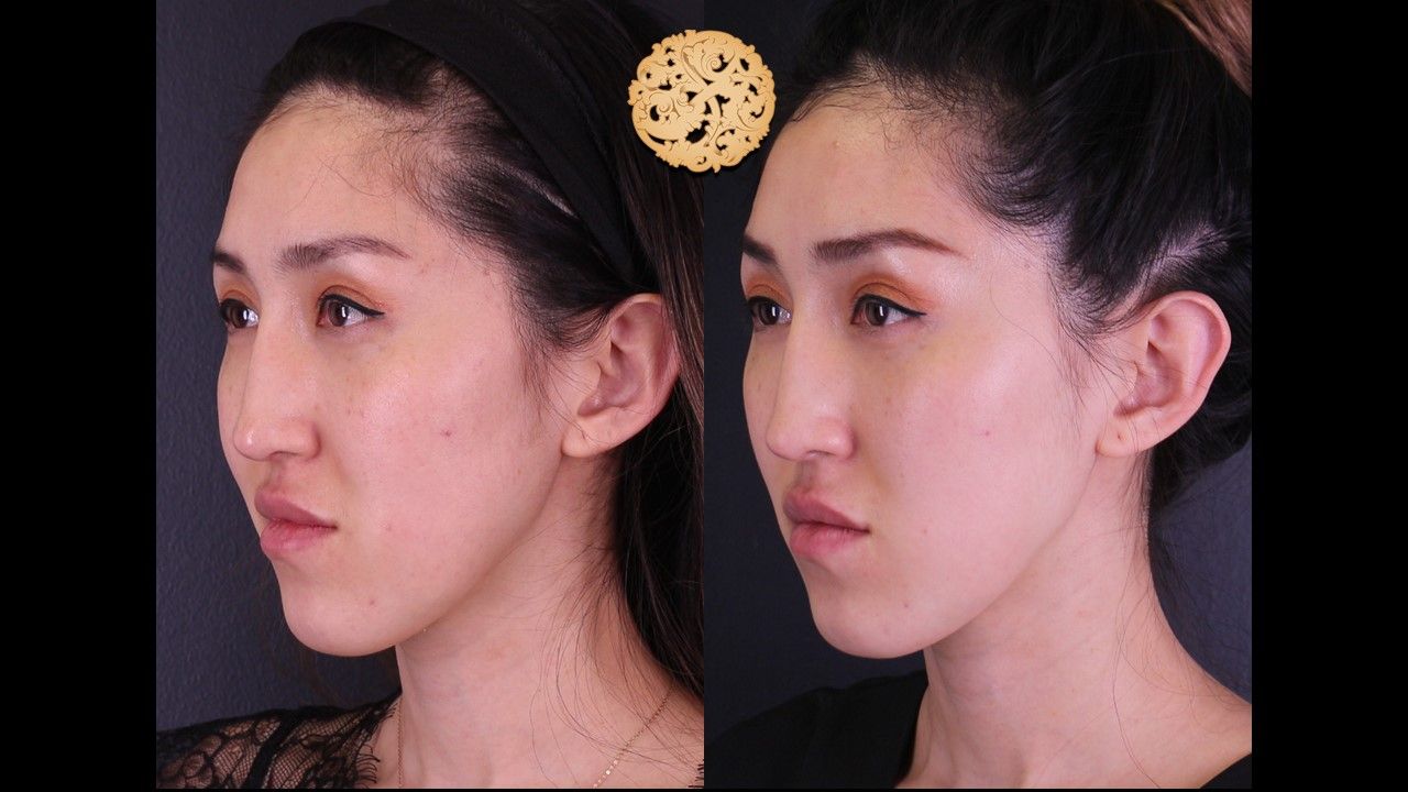 Vivace Before & After