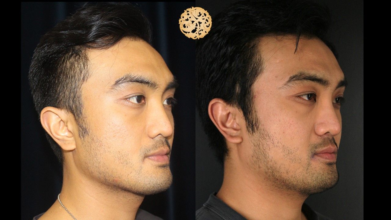 Vivace Before & After