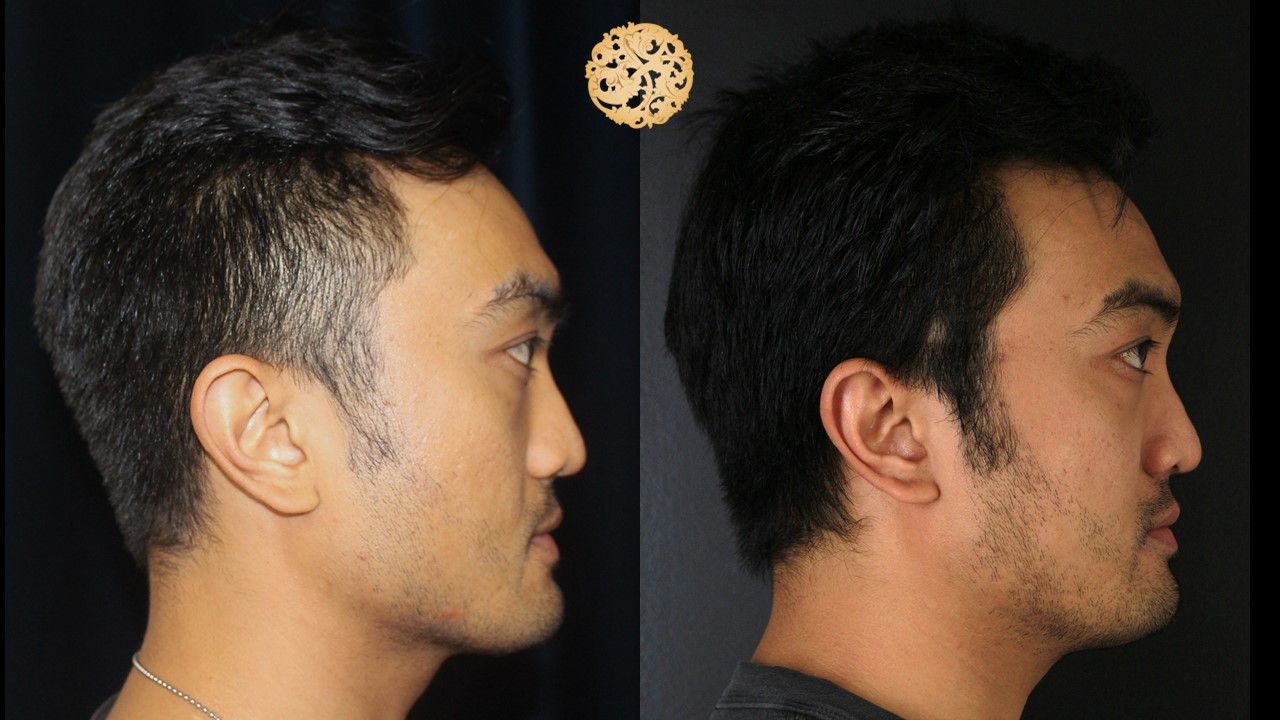 Vivace Before & After