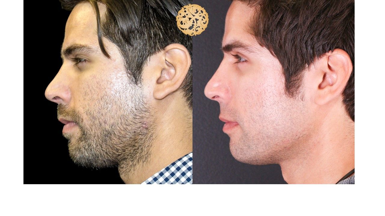 Vivace Before & After