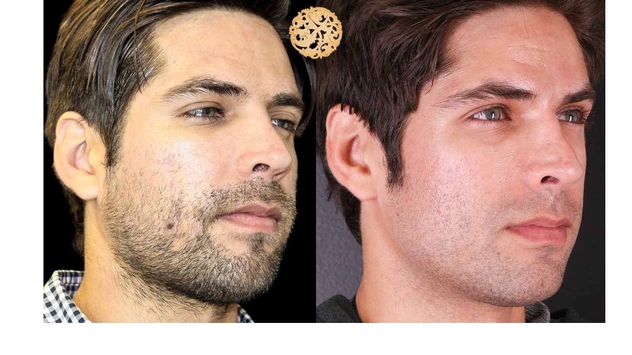 Vivace Before & After