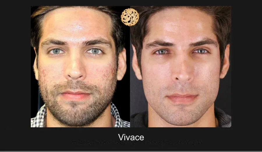 Vivace Before & After