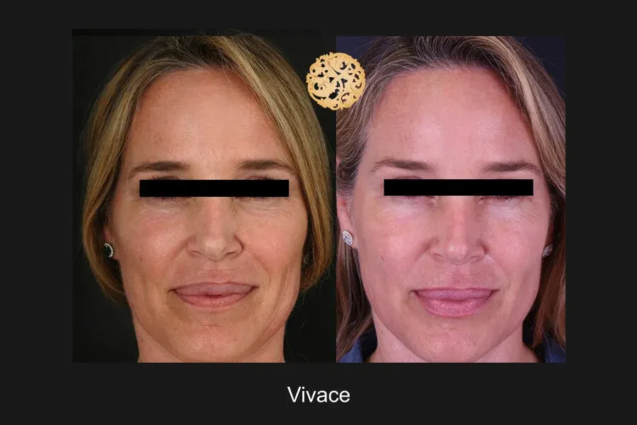 Vivace Before & After