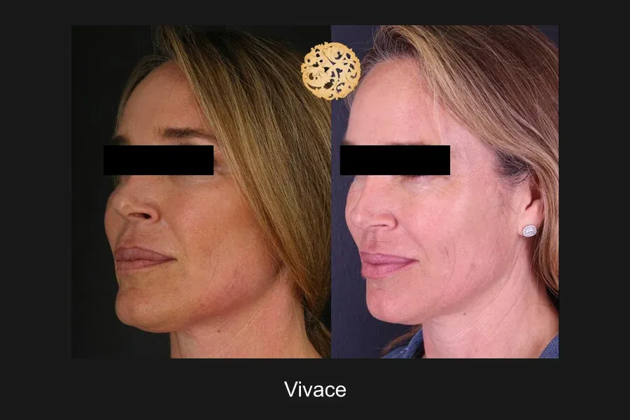 Vivace Before & After