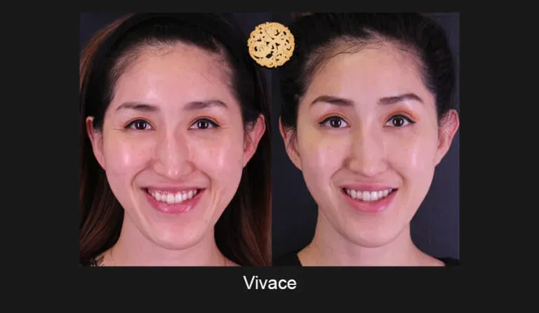 Vivace Before & After
