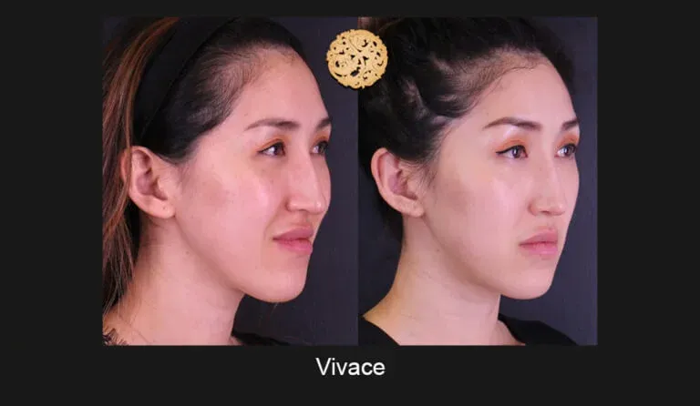 Vivace Before & After