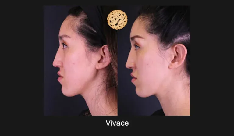 Vivace Before & After