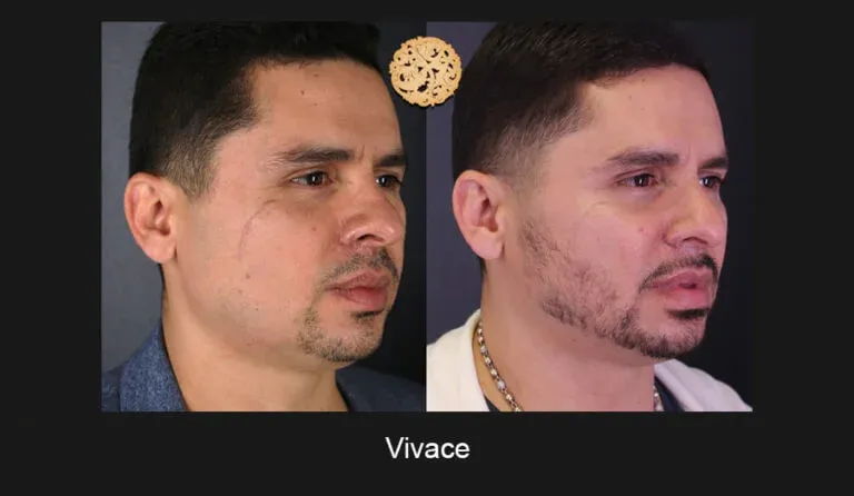 Vivace Before & After