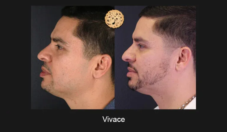 Vivace Before & After