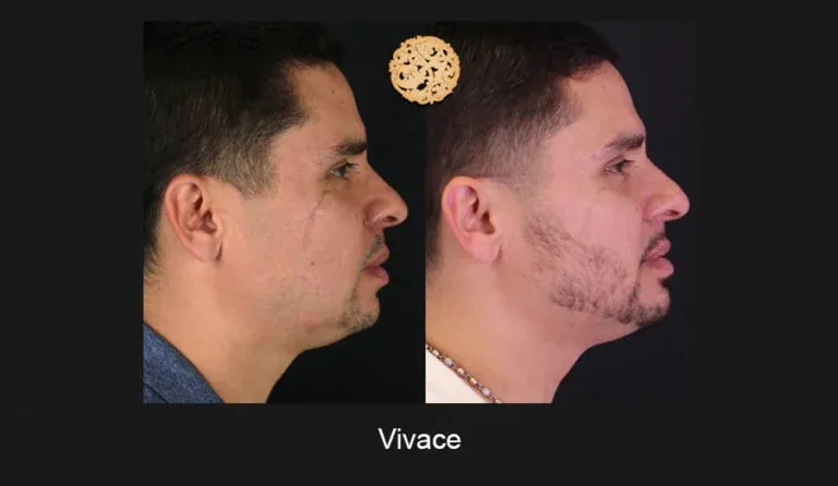 Vivace Before & After