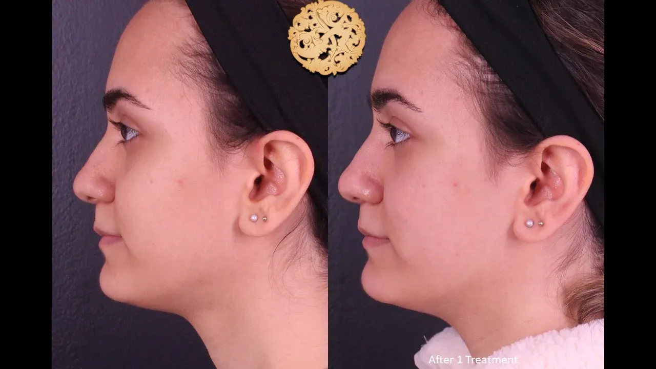 Vivace Before & After