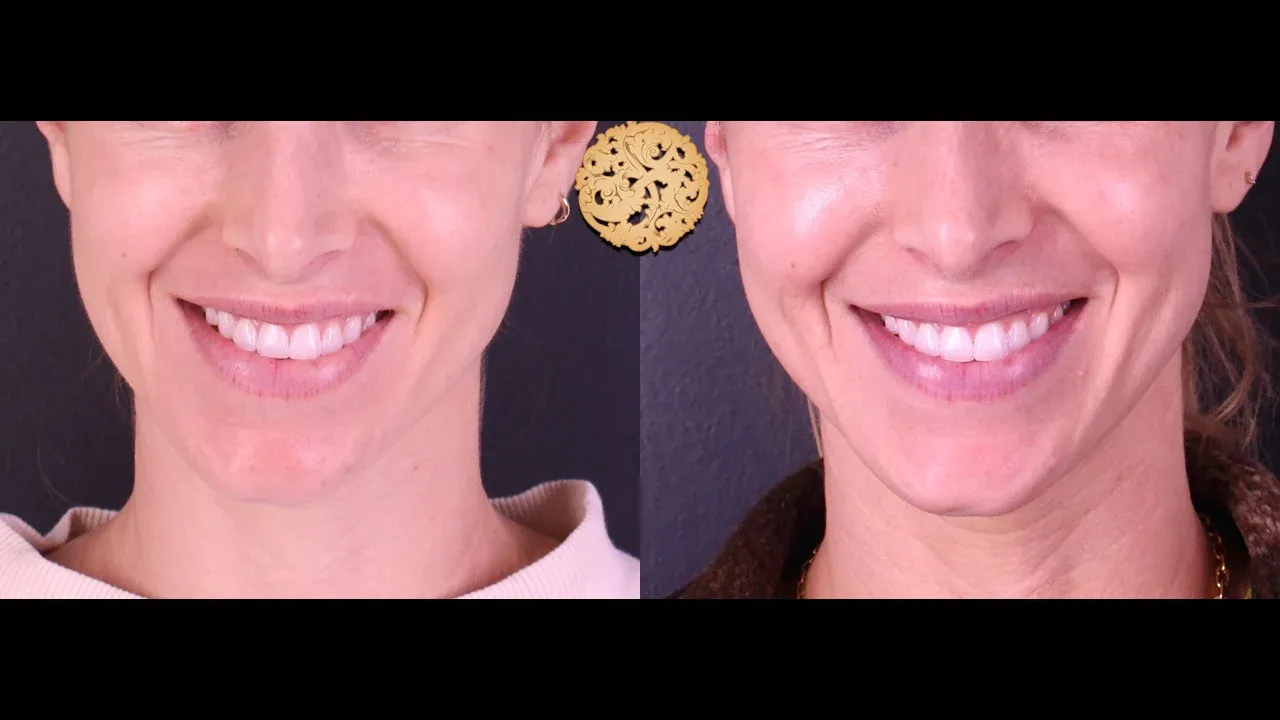 Vivace Before & After