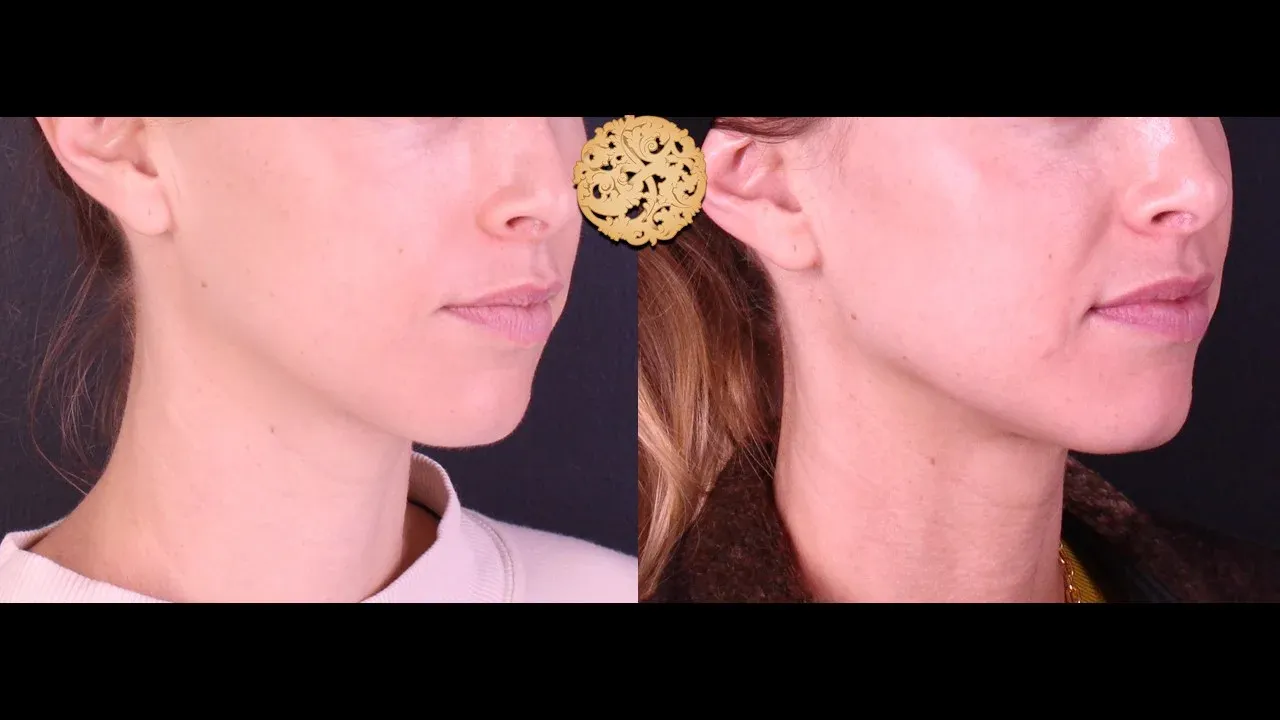 Vivace Before & After