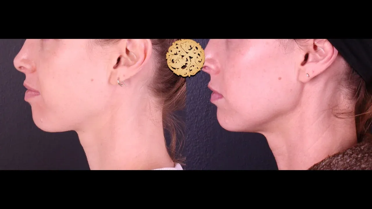 Vivace Before & After