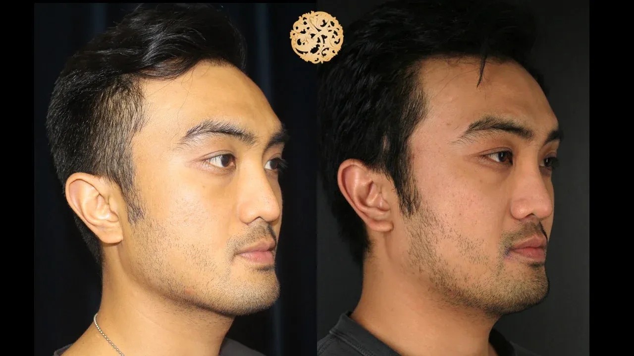 Vivace Before & After