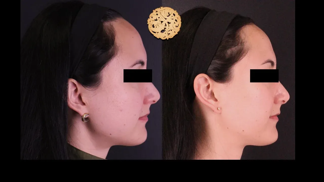 Vivace Before & After