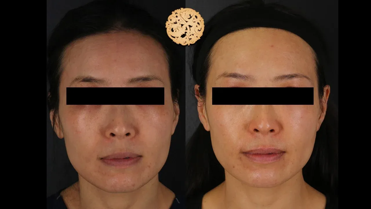 Vivace Before & After