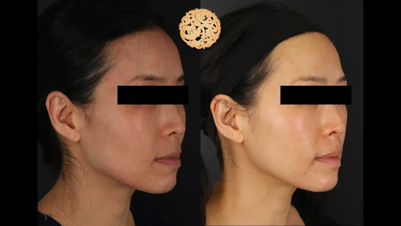 Vivace Before & After