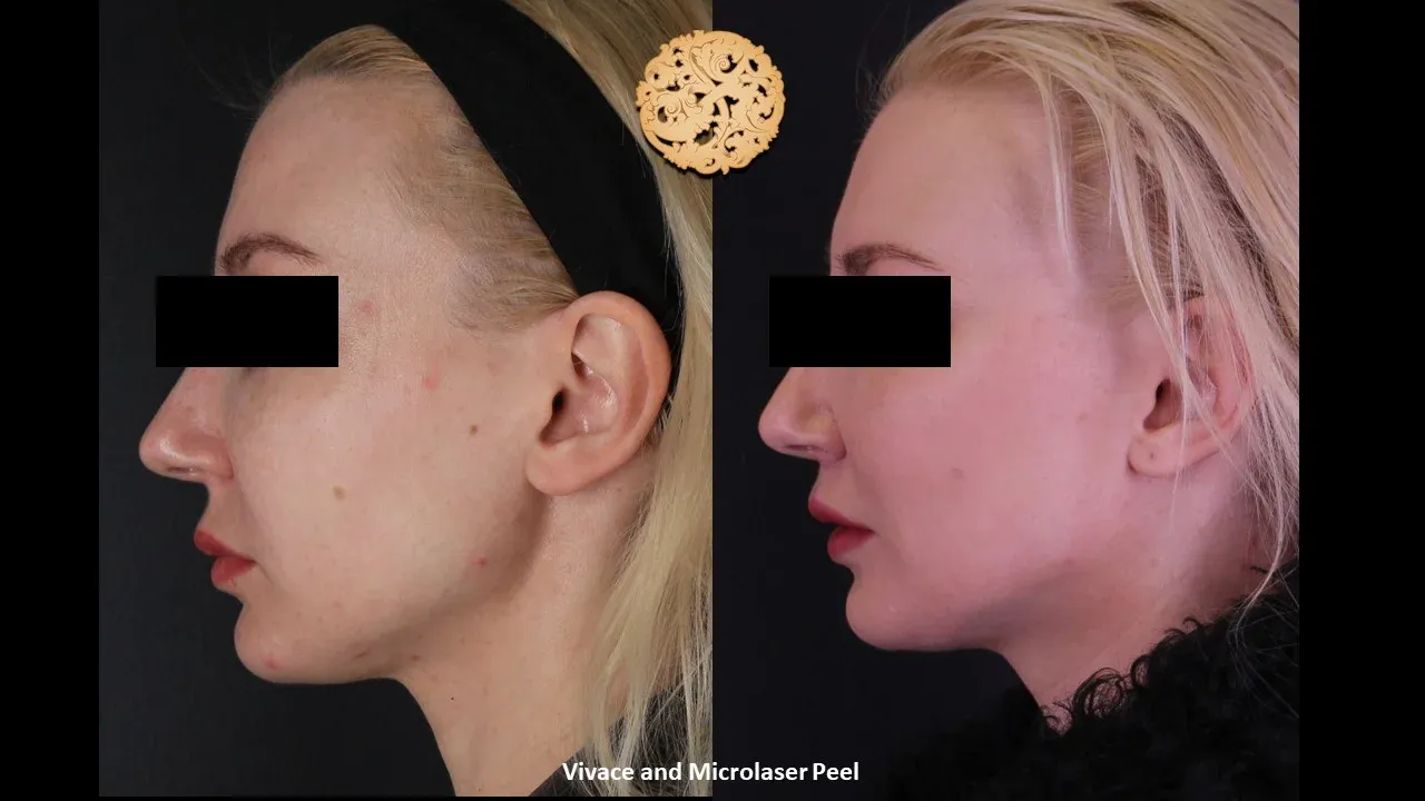 Vivace Before & After