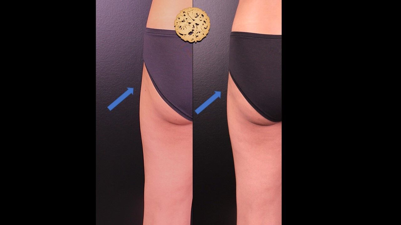 Sculptra Buttlift Before & After