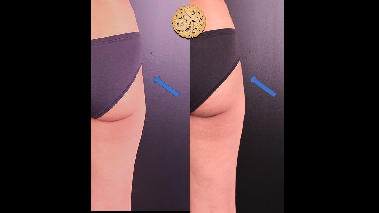 Sculptra Buttlift Before & After