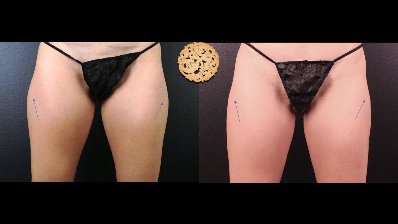 Sculptra Buttlift Before & After