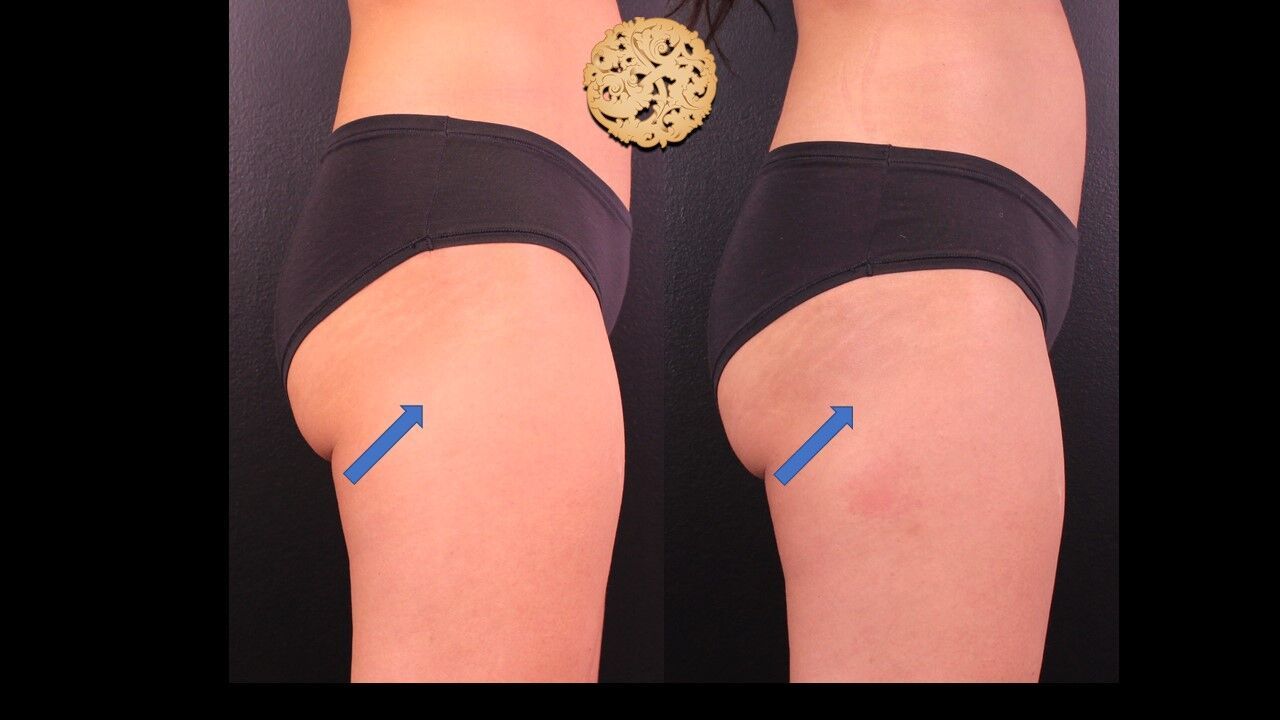 Sculptra Buttlift Before & After