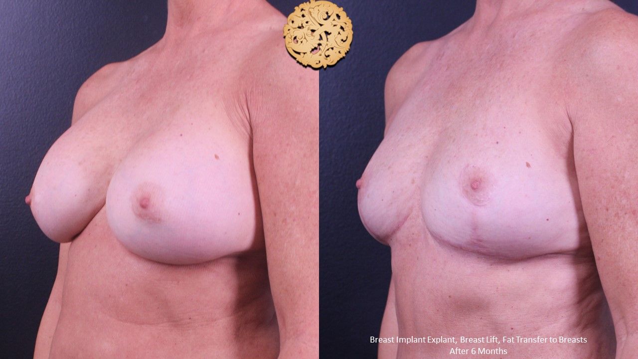 Breast Implant Removal Before & After