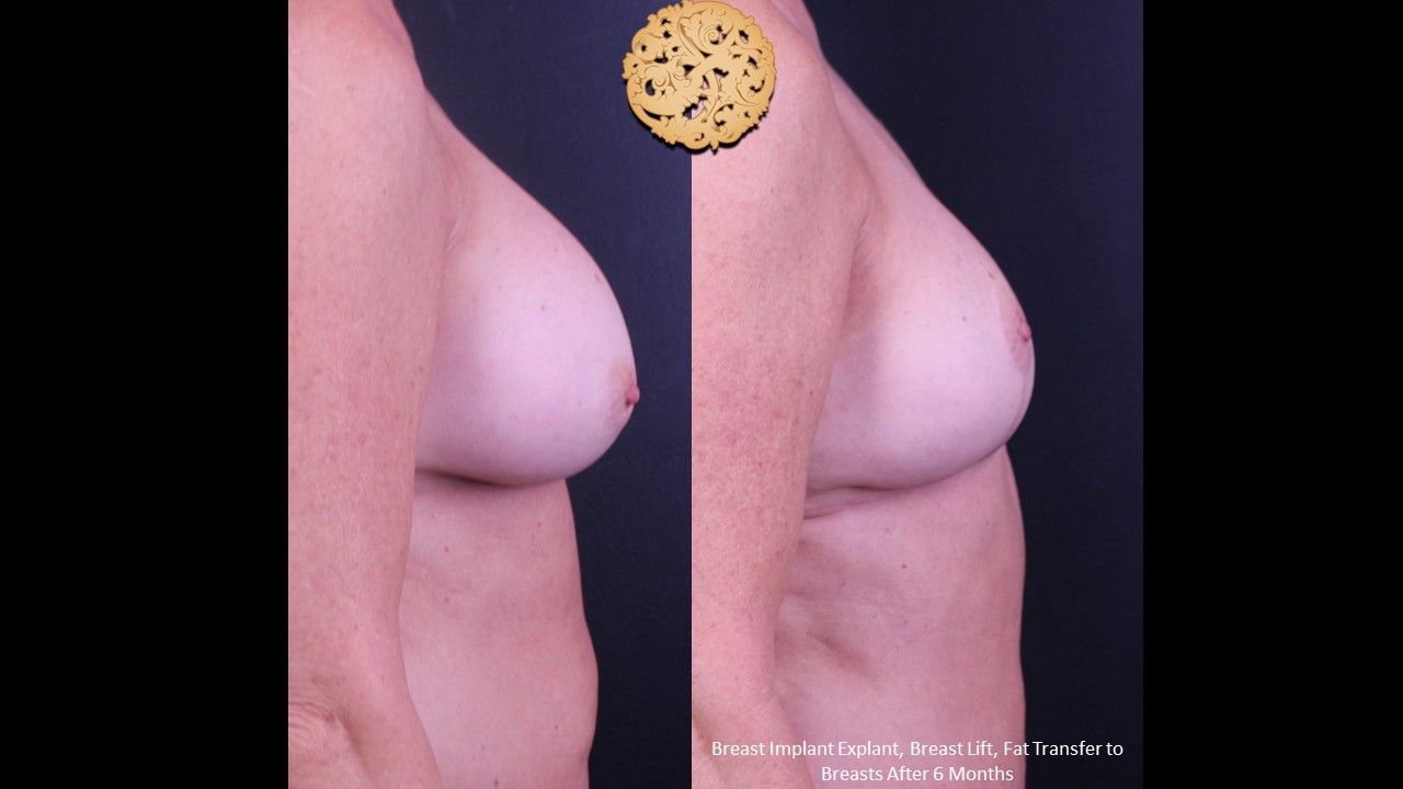 Breast Implant Removal Before & After