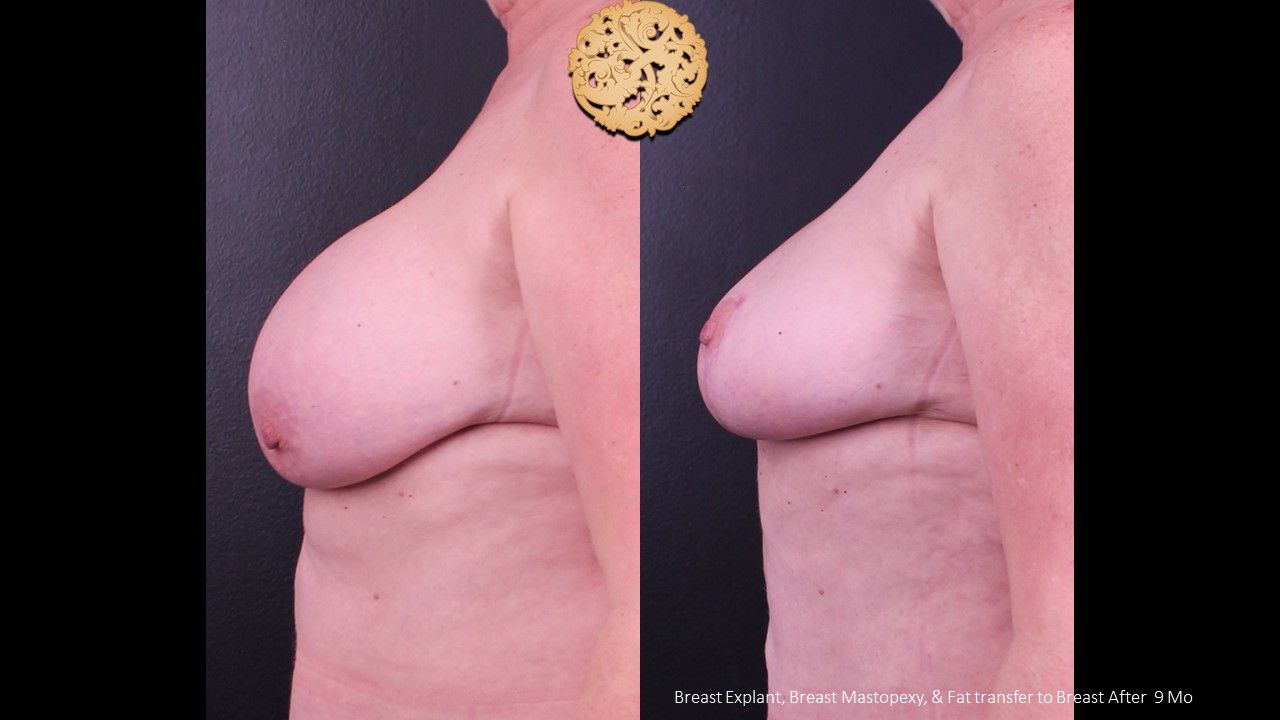 Breast Implant Removal Before & After