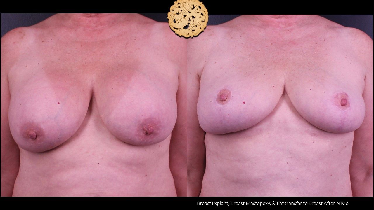 Breast Implant Removal Before & After