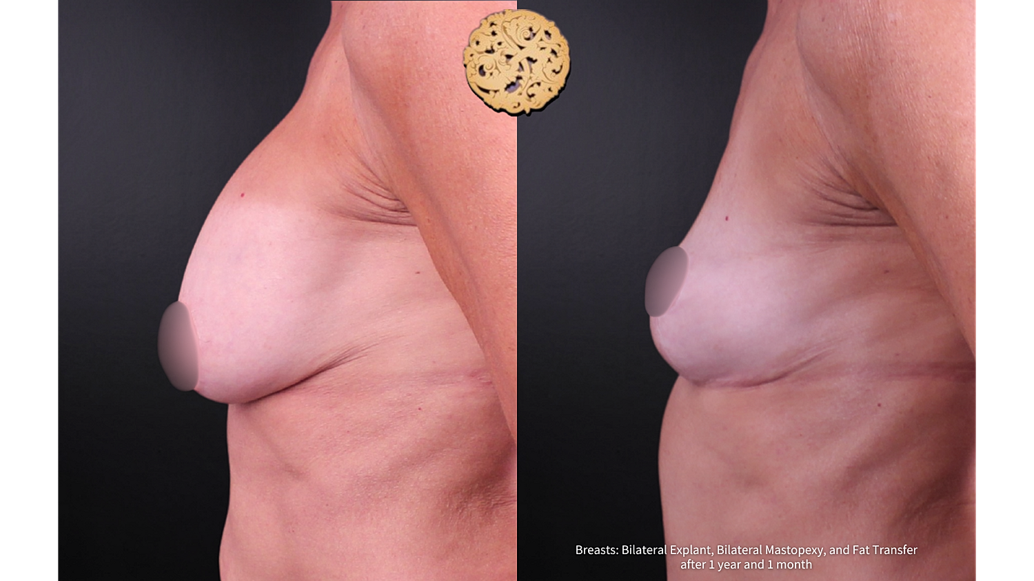 Breast Explant (Implant Removal) Before & After