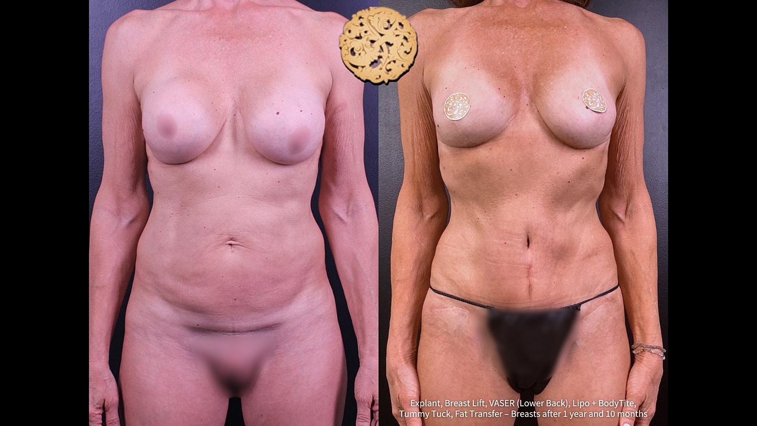 Breast Explant (Implant Removal) Before & After