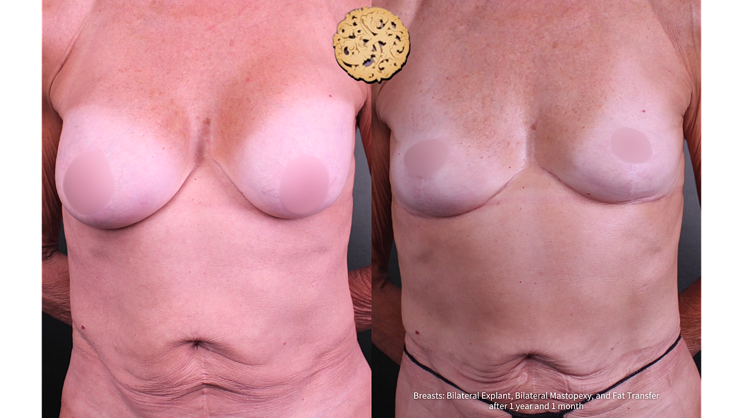 Breast Explant (Implant Removal) Before & After