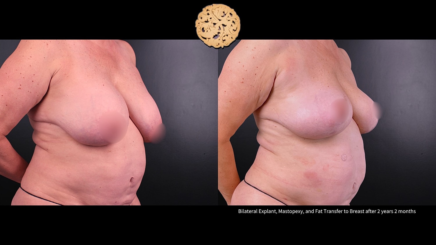 Breast Explant (Implant Removal) Before & After