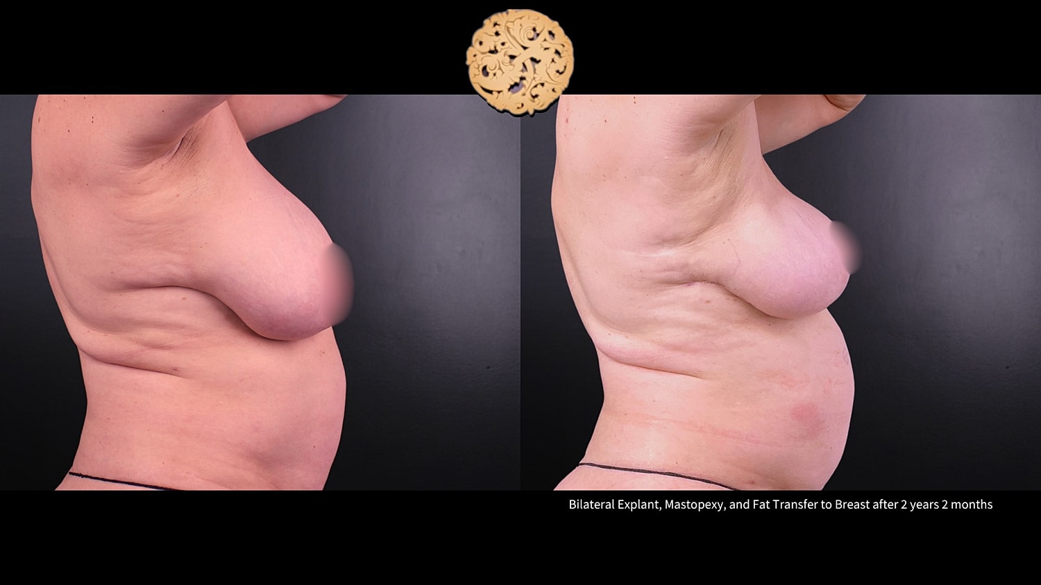 Breast Explant (Implant Removal) Before & After
