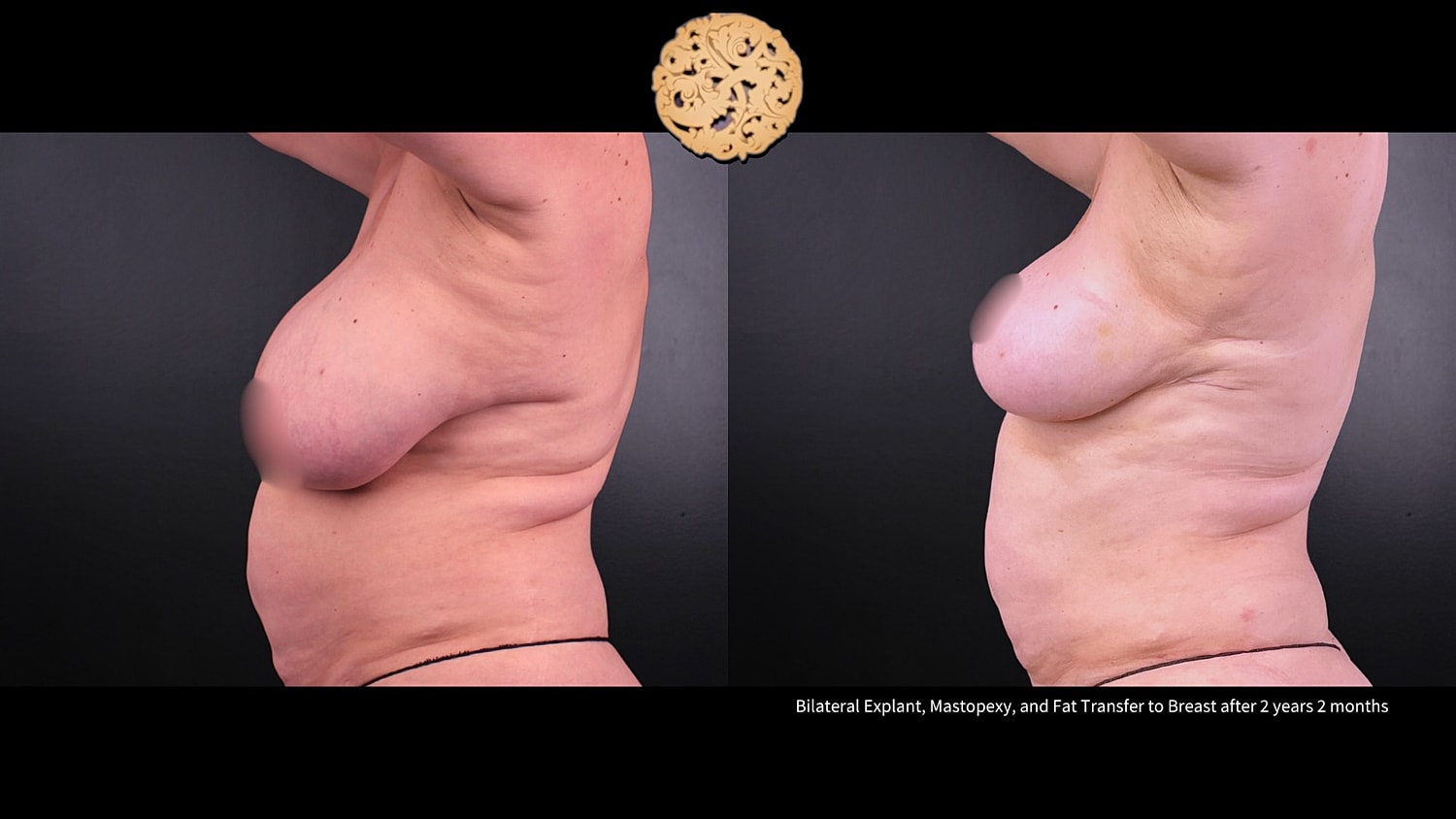 Breast Explant (Implant Removal) Before & After